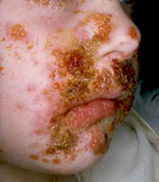 Impetigo - Dermnet: Dermatology Pictures - Skin Disease ...